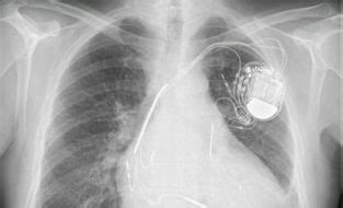 st. jude hospital scandal|st jude defibrillator lawsuit update.